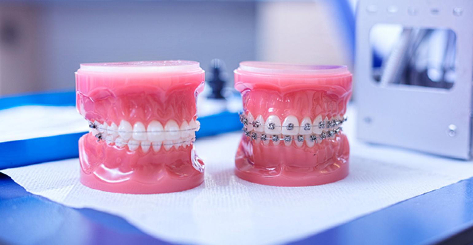 Prestatie Dragende cirkel verlangen ORTHODONTIE : Frequent gestelde vragen (F.A.Q.) | Tandartsendorp